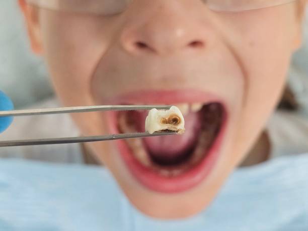 Best Knocked-Out Tooth (Avulsed Tooth) Treatment in Gonzales, LA